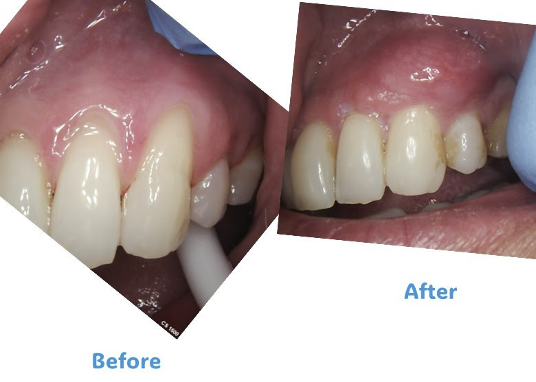 CaptBefore and After dental implant Caseure-2025-04-05-165601