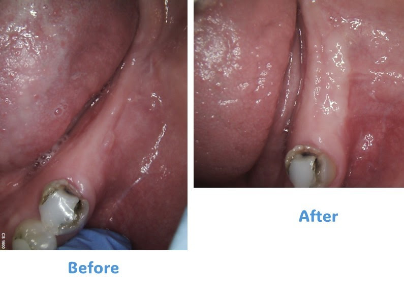 Before and After dental implant Case