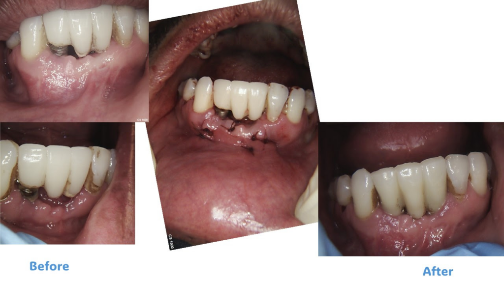 Before and After dental implant Case
