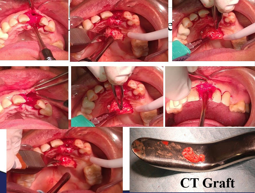 Ct Graft case
